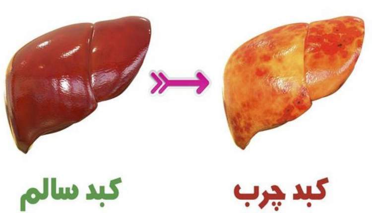 این بیماری را جدی بگیرید/ پیوند، در انتظار بیماران با عارضه کبد چرب