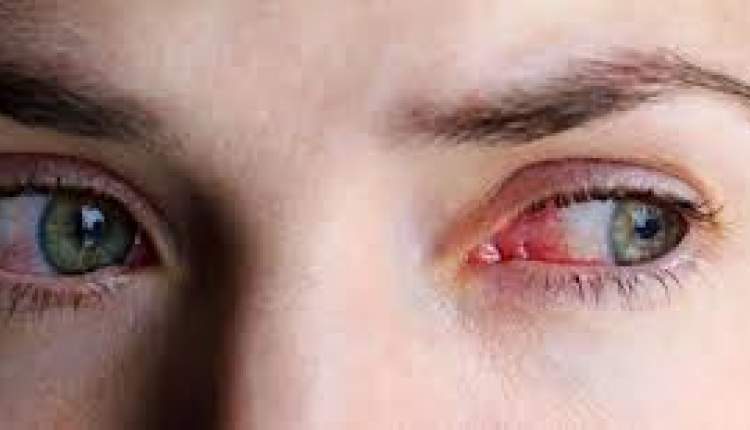 بروز علائم حساسیت‌های چشمی،  زنگ خطری برای ابتلا به کرونا