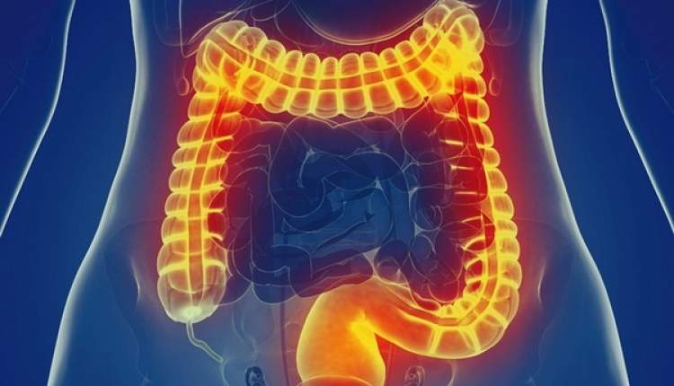 سندروم روده تحریک‌پذیر درمان قطعی ندارد
