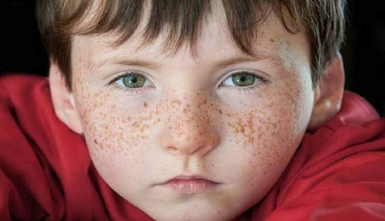 درمان کک و مک در کودکان زیر سن بلوغ توصیه نمی‌شود/ بهبود اگزمای پوستی سال‌ها به طول می‌انجامد