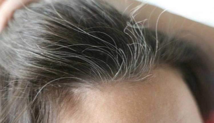 وراثت، بیماری‌ها و اضطراب، سه عامل سفید شدن موها/ ریزش مو بعد از ابتلا به کرونا با مکمل درمان می‌شود