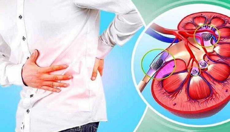 مصرف سه لیتر آب در طول روز توصیه پزشکان به افرادی که کلیه سنگ ساز دارند
